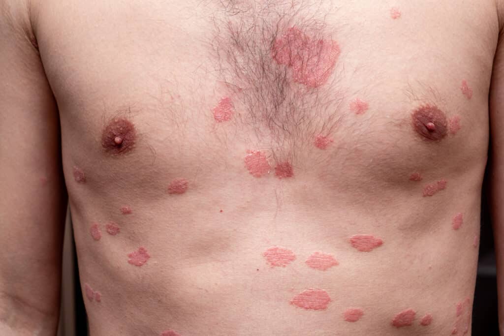 Lichen Sclerosus