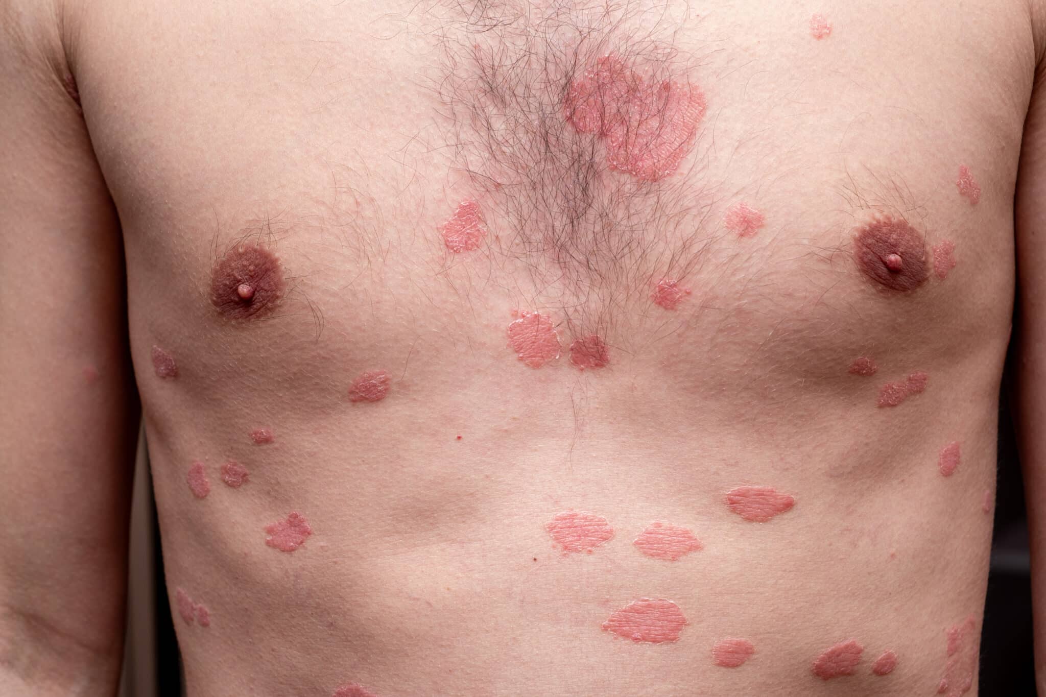 Lichen Sclerosus