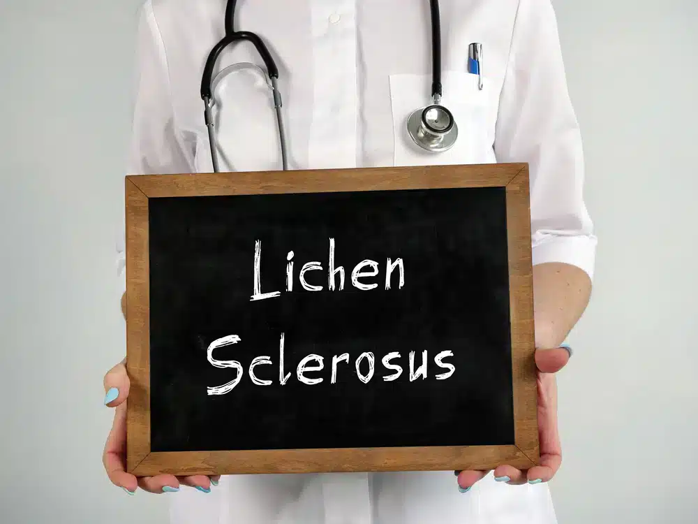 Lichen Sclerosus