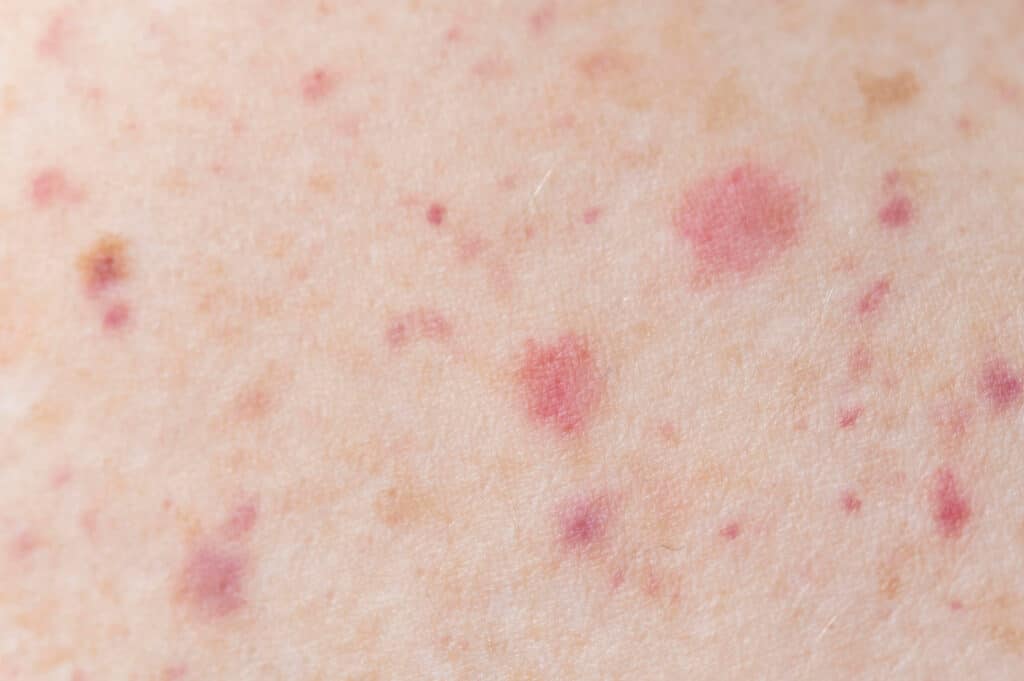 Lichen Sclerosus
