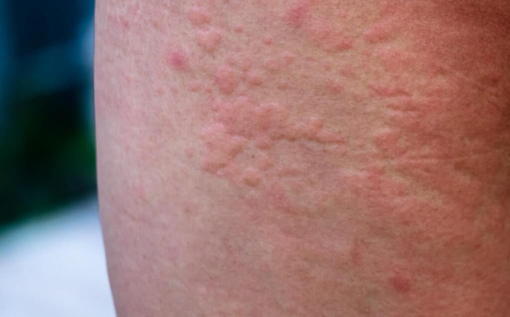 lichen sclerosus