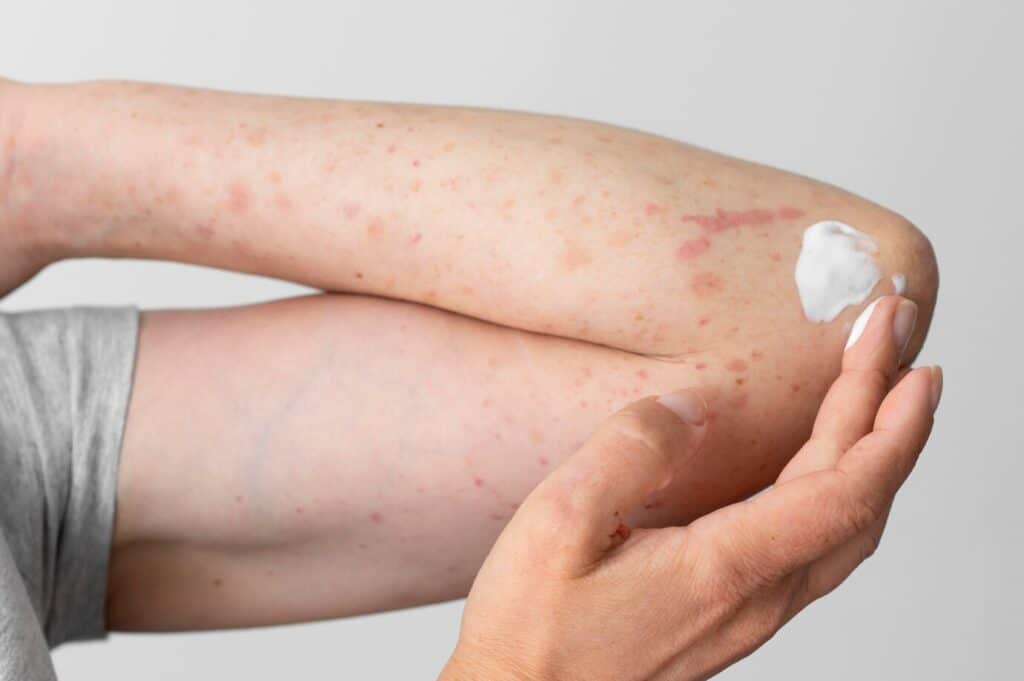 Lichen Sclerosus