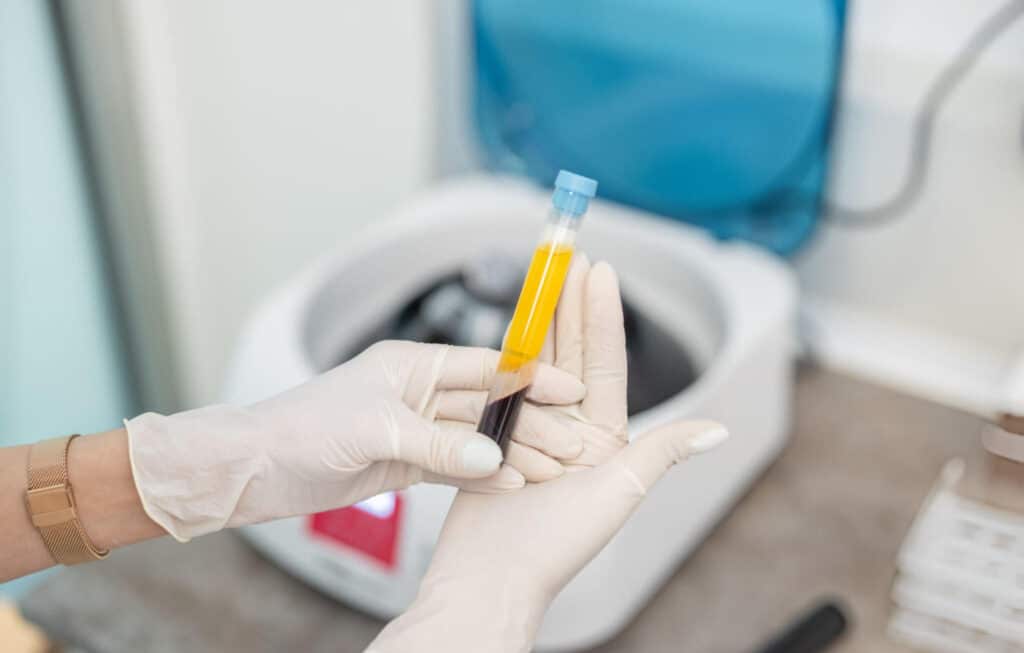 platelet rich plasma therapy