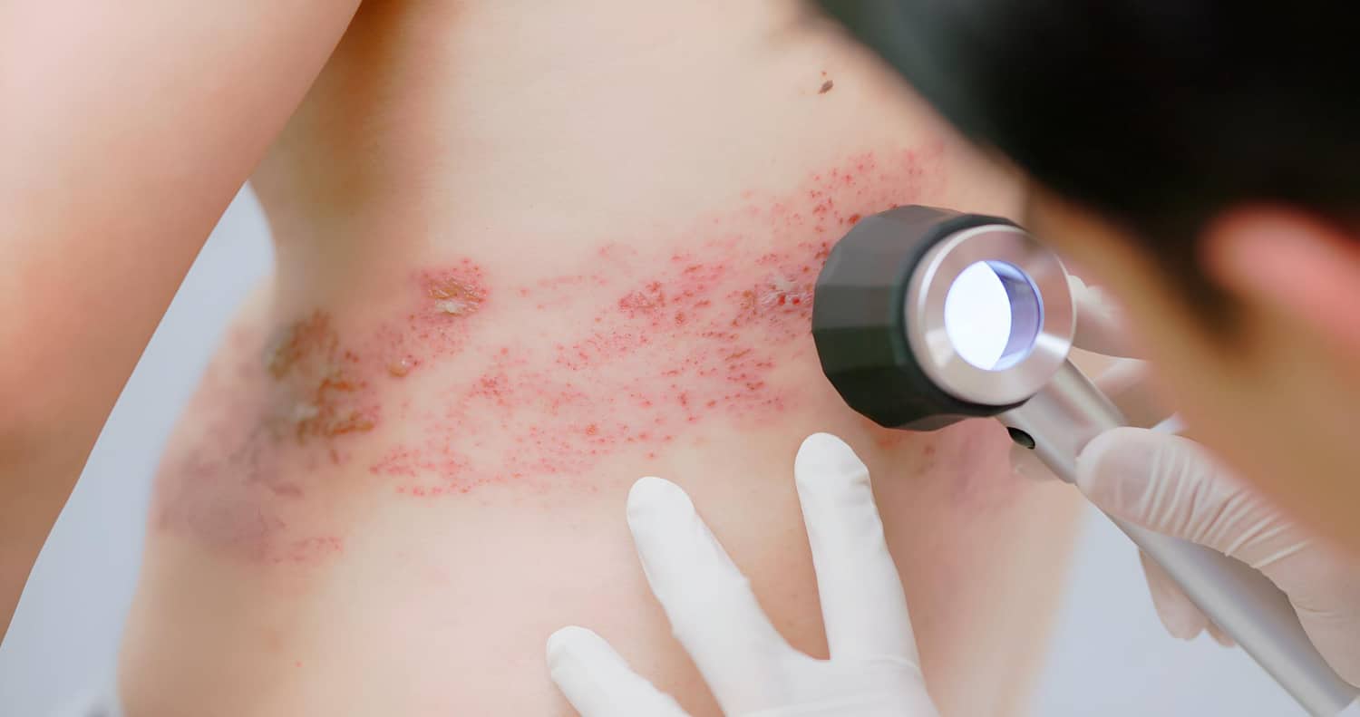 Lichen Sclerosus Treatments