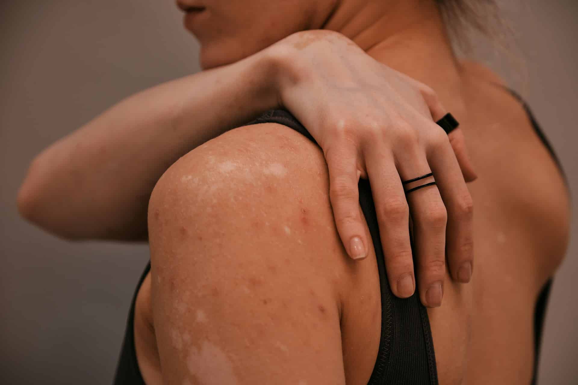 Lichen Sclerosus
