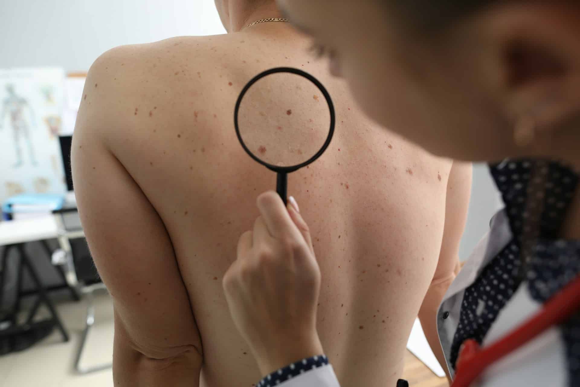 skin treatment